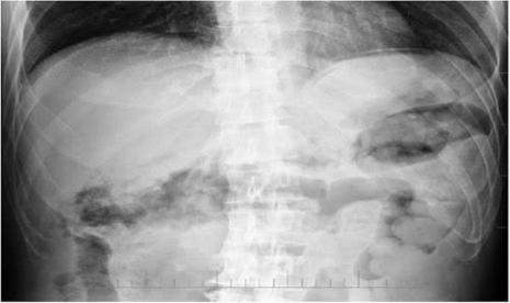 udara di peritoneum - ilustrasi berita Mengenal Pneumoperitoneum: Ketika Udara di Peritoneum Menandakan Masalah